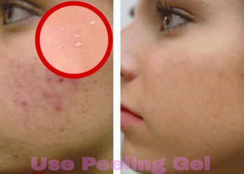peeling gel for acne scars