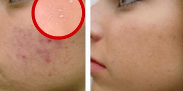 peeling gel for acne scars