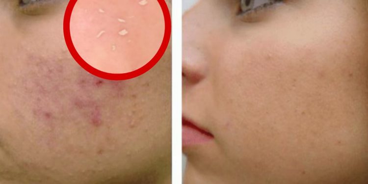 peeling gel for acne scars