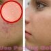 peeling gel for acne scars