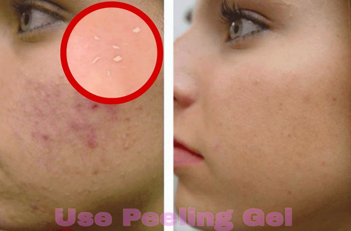 peeling gel for acne scars